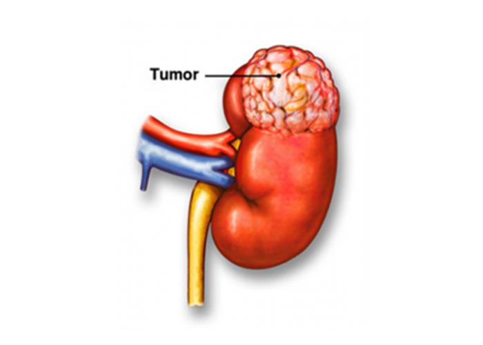 Câncer de rim