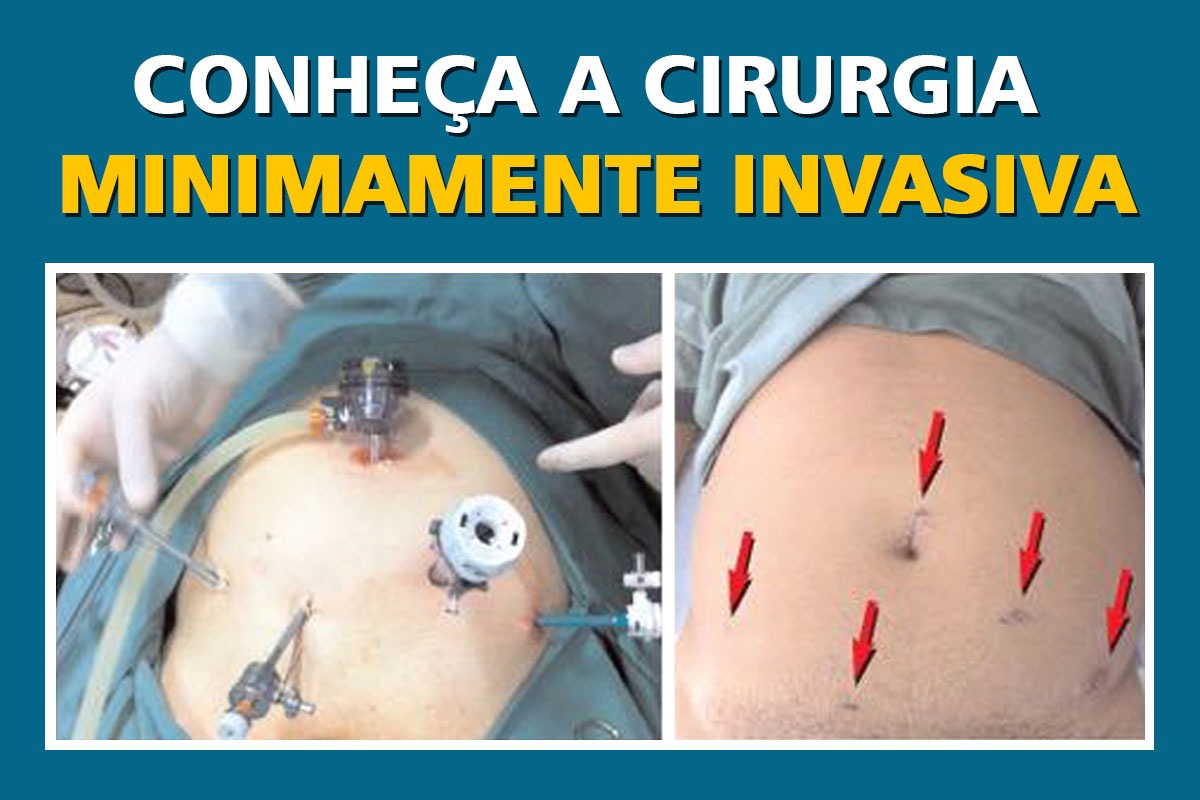 Videolaparoscopia: cirurgia minimamente invasiva - Clínica Wajman